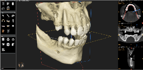 歯や顎の骨の状態を正確に把握する