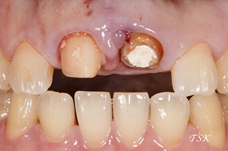 前歯部抜歯即時埋入の治療前