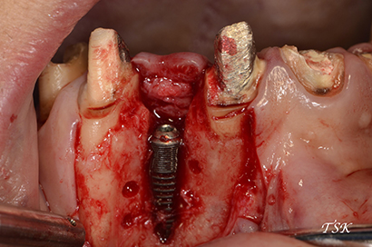上顎前歯部骨造成インプラントの治療前
