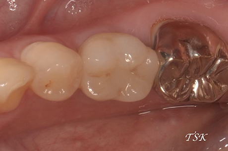 下顎臼歯部1本埋入の治療後