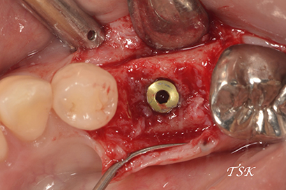 下顎臼歯部1本埋入の治療前