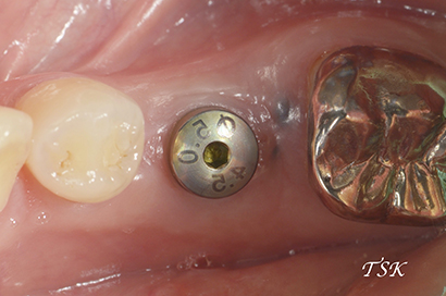 下顎臼歯部1本埋入の治療前