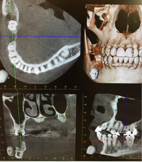 歯科用CT